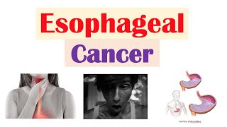 Esophageal Cancer  Risk Factors Pathogenesis Signs and Symptoms Diagnosis Treatment [upl. by Ezekiel509]