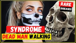 Cotards syndromesyndrome dead walking what is symptoms causes and treatment  Most rare disease [upl. by Anazus204]