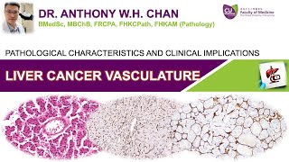 Liver Cancer Vasculature  Pathological Characteristics and Clinical Implications [upl. by Robillard]