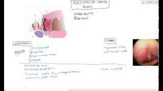 Peritonsillar Abscess Quinsy for USMLE Step 2 [upl. by Kipton]