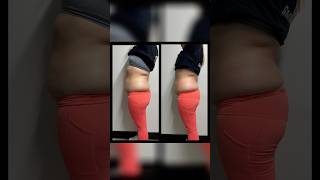 Results of cryoslimming cryotherapy cryoslimming cryotherapist [upl. by Pastelki]