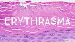 Erythrasma Corynebacterium minutissimum 5Minute Pathology Pearls Dermatopathology Dermatology [upl. by Snell]