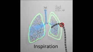 Pneumothorax Treatment Animation needle decompression and chest tube drainage Shorts [upl. by Azarria135]