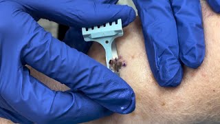 Malignant Melanoma Biopsy [upl. by Aynot926]