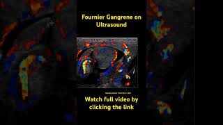 Fournier gangrene radiology radiologyresident medicine ultrasound dermatology [upl. by Mavra]