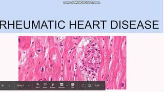 Rheumatic Heart Disease Pathogenesis Morphology Clinical features [upl. by Nema977]