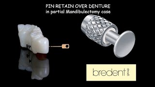 PIN RETAIN OVER DENTURE in Partial Mandibulectomy case [upl. by Pineda]