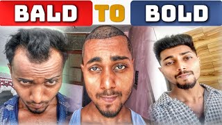 MY 15 MONTHS COMPLETE HAIR TRANSPLANT RESULTS  HAIR TRANSPLANT RESULTS [upl. by Ahsiyn]