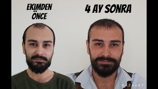 SAÇ EKİMİ 4 AY SONUÇLARI [upl. by Ednargel]