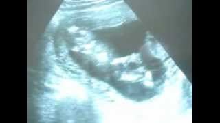 13 weeks and 5 days pregnantBest SonogramUltrasound Ever [upl. by Osbourne482]