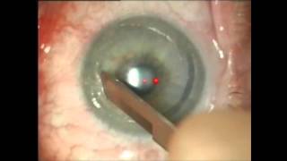 Phototherapeutic Keratectomy  Superficial Keratectomy for Irregular Astigmatism West Des Moines Iow [upl. by Adnorhs542]