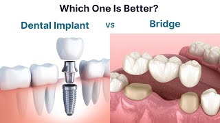 Dental Implant vs Bridge Which one is better to replace a missing tooth [upl. by Dolhenty43]