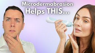 7 Surprising Benefits of Microdermabrasion for Your Skin [upl. by Yanat]