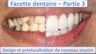 «Il aura un dentier à 30 ans»  la tendance des dents limées inquiète les dentistes [upl. by Enitsuga564]