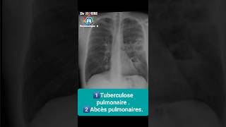 chest xray radiologiest radiographie thoracique doctor duet [upl. by Radford]