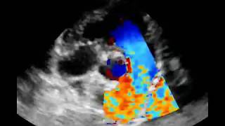 Estenosis pulmonar tipoA [upl. by Ahsaf]