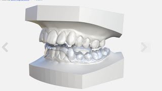 How to design a Morning Repositioner in 3Shape [upl. by Yltsew]