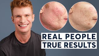 Acne Scar Removal  Real People True Results [upl. by Hcurob]