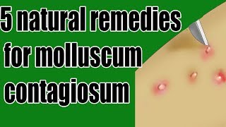 Home Remedies for Molluscum Contagiosum Simple Get Rid Molluscum Contagiosum [upl. by Ilyak]