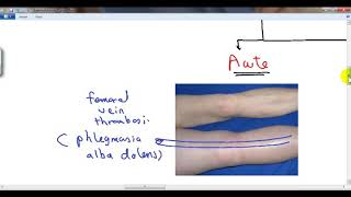 GENERAL PATHOLOGY 40  hyperaemia and oedema DR SAMEH GHAZY [upl. by Kalb]