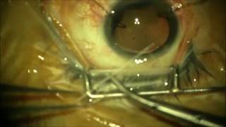 Management of traumatic cataract with 180 degree zonular dialysis and traumatic mydriasis [upl. by Kcuhc]