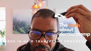 Week 18   month 4  Turkey Hair transplant The derma stamp [upl. by Richel]