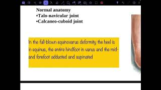 Congenital talipes equinovarus part 1 [upl. by Marsiella]