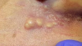 Whiteheads Blackheads Extractions on the Ear [upl. by Edholm]