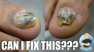 TRYING TO FIX A DAMAGED amp DEFORMED BIG TOENAIL [upl. by Polivy]