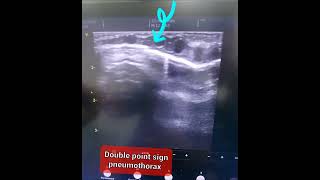 Neonatal Lung Ultrasound  Identifying the Double Point Sign in Pneumothorax pocus neonates [upl. by Salohci715]