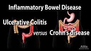 Ulcerative Colitis versus Crohns Disease Animation [upl. by Parrisch807]