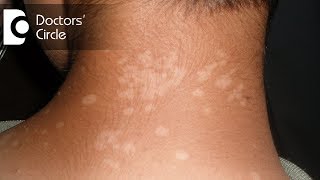 Pharmacological management of Tinea Versicolor in young individuals  Dr Urmila Nischal [upl. by Bergmann]