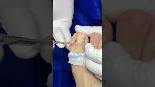 Cauterización de uña ingrowntoenailsurgery satisfying onicocriptosis [upl. by Noruq]