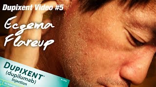 Allergic to DUPIXENT or Topical Steroid Withdrawal TSW Eczema  Ep215 [upl. by Subak]