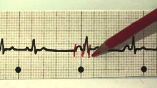 EKG für Pflege Teil 17  Supraventrikuläre Extrasystolen interpretieren SVES [upl. by Ileyan]