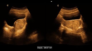 Arcuate uterus  Thickened endometrium  Ultrasonography report  Amader hospital  আমাদের হাসপাতাল [upl. by Utica]