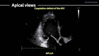 〖Echocardiography〗 Dilated CMP  Myocarditis [upl. by Gnaht]