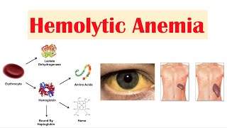 Hemolytic Anemia [upl. by Ennahoj]