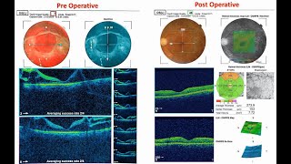 Vitrectomy for Advance Diabetic Eye Disease to The Best result II Dr Billal Hossain [upl. by Willman]