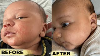 How To Get Rid Baby Acne FAST [upl. by Slinkman]