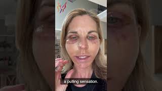 My Advanced Facelift Recovery Day by Day  Real Stories By Real Patients 2022 [upl. by Zevahc387]