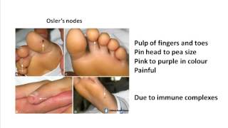 Oslers nodes and Janeway lesions [upl. by Hamid]