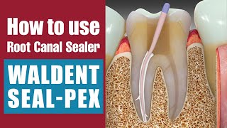 How to use Root Canal Sealer  Waldent SealPex [upl. by Ahsinit]