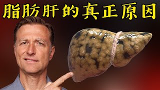 脂肪肝的真正原因自然療法柏格醫生 Dr Berg [upl. by Tenner238]