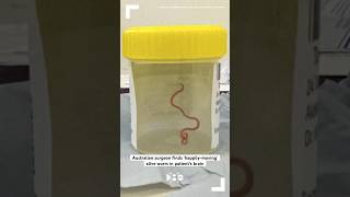 Australian surgeon removes ‘happilymoving’ alive worm from patient’s brain [upl. by Cahra]