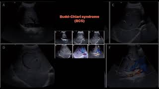 BuddChiari syndrome BCS [upl. by Kcirrek]