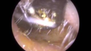 191 BEATING Eardrum visible after simple Ear Wax Removal  Mr Neel Raithatha The Hear Clinic [upl. by Ellednahc]