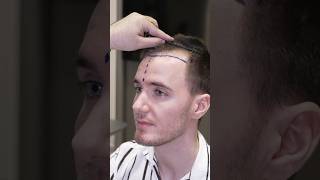 Cosmedica Clinic Hair Transplant in Turkey shorts hairtransplant video [upl. by Ayekim160]