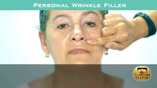 KEDMA Personal Wrinkle Filler in Action [upl. by Noteek]