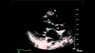 Coronary Sinus Atrial Septal Defect Parastermal Long Axis View with Dilated Coronary Sinus [upl. by Ranger855]